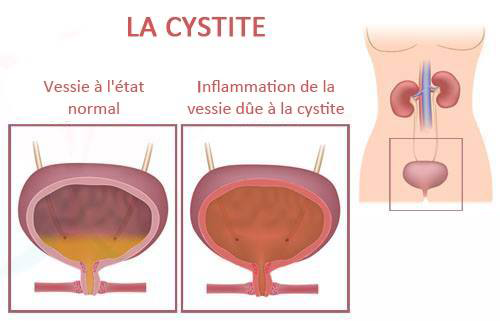 Schéma de l'inflammation d'une cystite